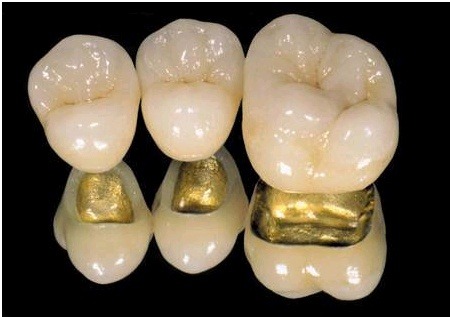 임플란트 재료 중 PFG를 이용하여 실제로 구현한 치아 사진입니다.