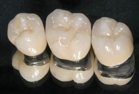 임플란트 재료 중 PFM을 이용하여 실제로 구현한 치아 사진입니다.
