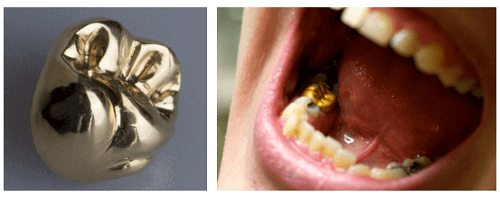 임플란트 재료 중 골드를 이용하여 실제로 구현한 치아 사진입니다.