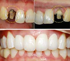 임플란트 재료 중 올세라믹을 이용하여 실제로 구현한 치아 사진입니다.