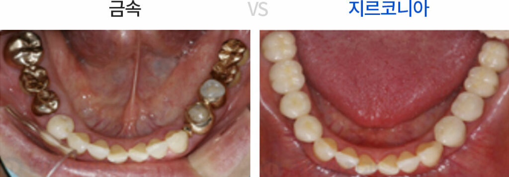 임플란트 재료 중 지르코니아를 이용하여 실제로 구현한 치아 사진입니다.